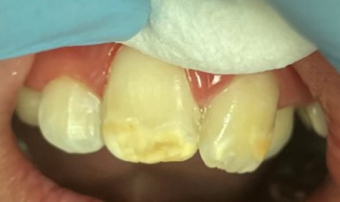 Brown spot removal case before procedure